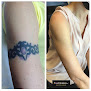 Removery Tattoo Removal & Fading Laser Tattoo Removal