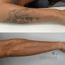 Removery Tattoo Removal & Fading Laser Tattoo Removal