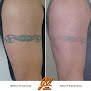 Removery Tattoo Removal & Fading Laser Tattoo Removal