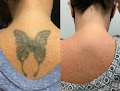 Removery Tattoo Removal & Fading Laser Tattoo Removal