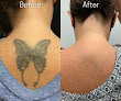 Removery Tattoo Removal & Fading Laser Tattoo Removal