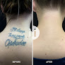Removery Tattoo Removal & Fading Laser Tattoo Removal