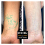 Renewal Tattoo Removal Laser Tattoo Removal