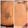 Rethink Laser Tattoo Removal Laser Tattoo Removal