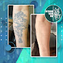 Rethink Your Ink Laser Tattoo Removal Laser Tattoo Removal