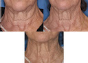 Ringpfeil Advanced Dermatology Laser Tattoo Removal