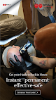 Scalp International Hairlines North Carolina Laser Tattoo Removal