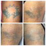Shipers Laser Tattoo Removal Center Dallas Laser Tattoo Removal