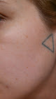 Signature Laser Tattoo Removal - Nashville Laser Tattoo Removal