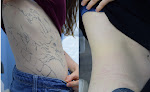 Skin Deep Laser Services Laser Tattoo Removal