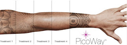 Skin Perfections Studio Laser Tattoo Removal
