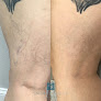 Skintellect Laser & Aesthetics Laser Tattoo Removal