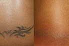 South Coast Medspa Laser Tattoo Removal