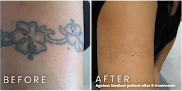 South Florida Laser Tattoo Removal Laser Tattoo Removal
