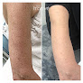 Spa Trouvé Laser Tattoo Removal