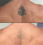 Sparkle Laser Hair/Tattoo Removal Laser Tattoo Removal
