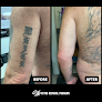 Sw Tattoo Removal Program Laser Tattoo Removal