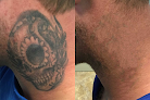 Taketatt Tattoo Removal Laser Tattoo Removal