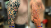 Taketatt Tattoo Removal Laser Tattoo Removal