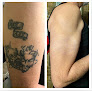 Tattoo Bill’s Charlotte Laser Tattoo Removal