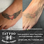 Tattoo R&R Laser Tattoo Removal