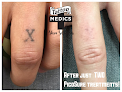 Tattoomedics Laser Tattoo Removal Laser Tattoo Removal