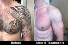Tattooremovers.ink Laser Tattoo Removal