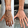 The Laser Guy Tattoo Removal Laser Tattoo Removal