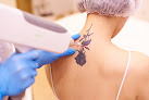 The Spa By Sheena Laser Tattoo Removal
