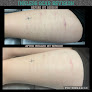 Torque Tattoo Laser Tattoo Removal