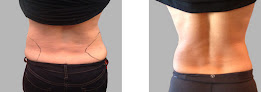 Total Body Laser & Med Spa Laser Tattoo Removal
