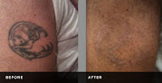 Tri-County Laser Center Laser Tattoo Removal