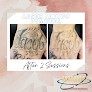 Unbranded Austin - Laser Tattoo Removal Laser Tattoo Removal