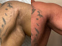 Utah Scar And Stretch Mark Lab Laser Tattoo Removal