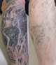 Vanish Skin Aesthetics And Laser Tattoo Removal Laser Tattoo Removal