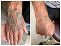 Vanish Tattoo Removal Laser Tattoo Removal