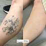 Vanishing Ink Med-Spa & Wellness Laser Tattoo Removal