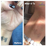 Wichita Laser Clinic Laser Tattoo Removal