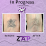 Zap Tattoo Removal In Plano, Tx Laser Tattoo Removal