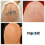 Zapatat Herndon Laser Tattoo Removal