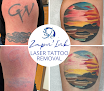 Zapn'ink Laser Tattoo Removal Laser Tattoo Removal