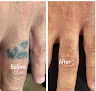 Zeiva Professional Center Laser Tattoo Removal